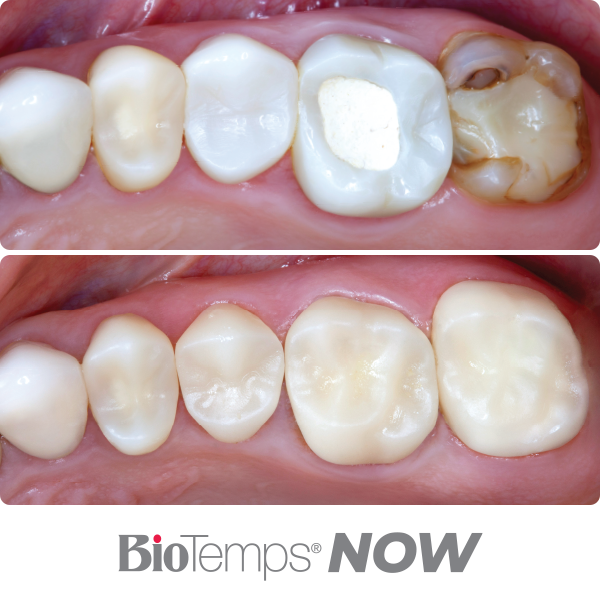 material-before-after-biotemps-NOW_600x600-1