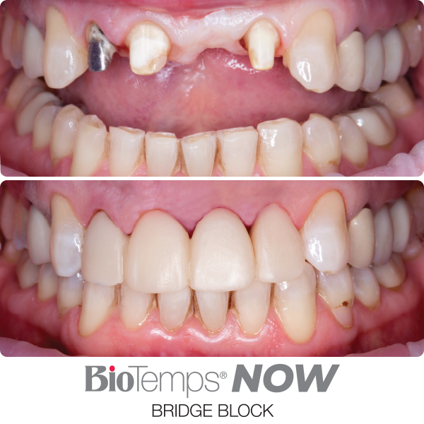 material-before-after-biotemps-now-bridge-block_600x600-1