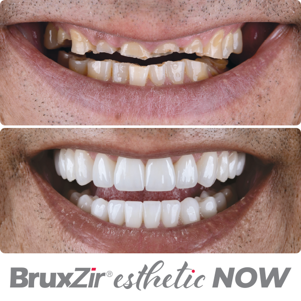 material-before-after-bruxzir-esthetic-now_600x600-1