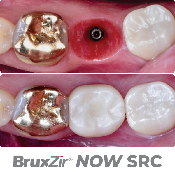 material-before-after-bruxzir-now-src_600x600