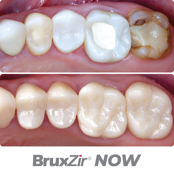 material-before-after-bruxzir-now_600x600-1